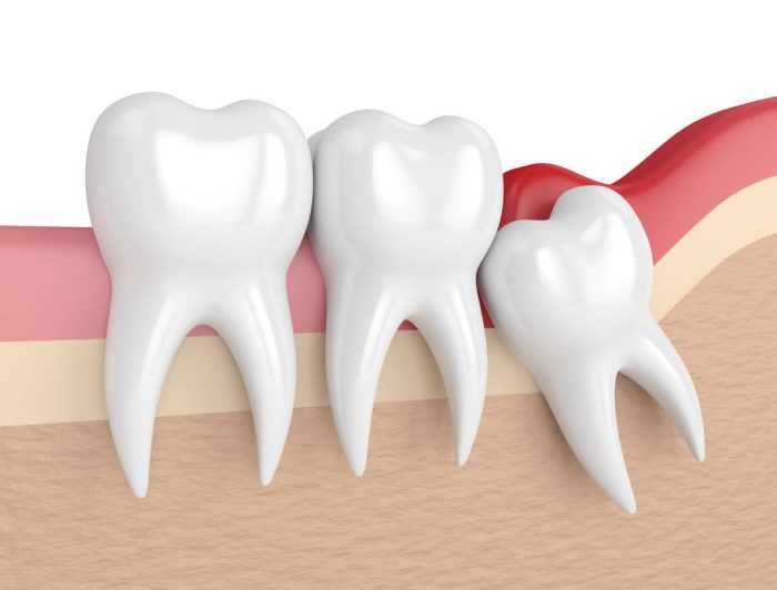 Impacted Wisdom Teeth Extraction Near Me | Extract Wisdom Teeth