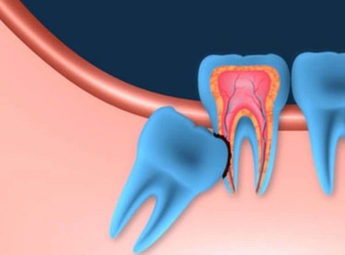 Impacted Wisdom Teeth Extraction Near Me | Extract Wisdom Teeth