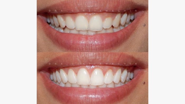 Porcelain Veneers Near Me