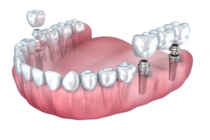 Affordable Dental Implants Houston, TX