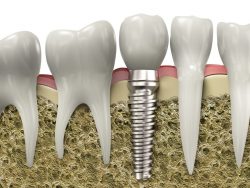 Dental Implants Service in North Miami