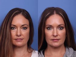 How Much Does Eye Lift Surgery Cost?