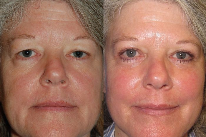 How Much Does Eye Lift Surgery Cost?