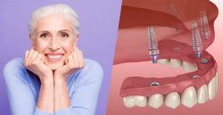 Dental Implant Dentist in Houston TX