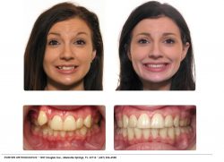 Adult braces before and after