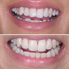 Adult braces before and after