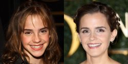 Celebrity Before And After Dentures Result