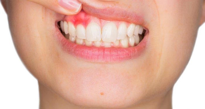 Tooth Abscess Stages, Symptoms & Treatment