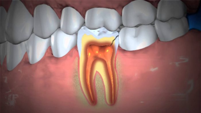 Treatment For An Abscessed Tooth