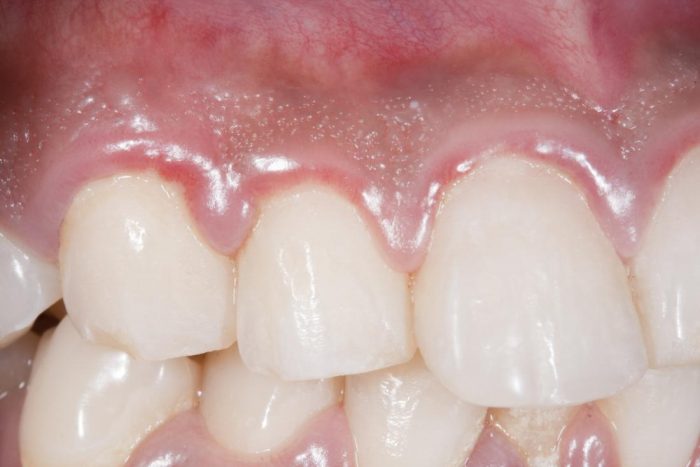 What Is The Treatment For Gingivitis?
