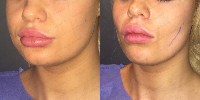 Best Cheek Reduction Surgery