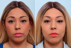 Benefits of a Cheek Reduction