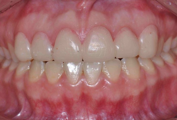 Periodontitis Gingivectomy Houston