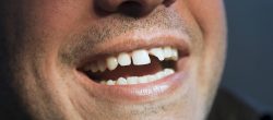 Dental Veneers for Cracked Teeth