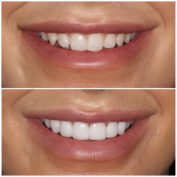 Porcelain Veneers Before And After | Dental Veneer Houston