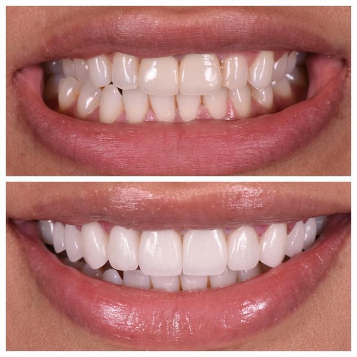 How Much Do Veneers Cost? What Problems Do Veneers Fix?