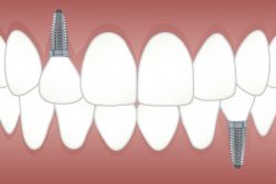 All On 4 Dental Implants in Aventura
