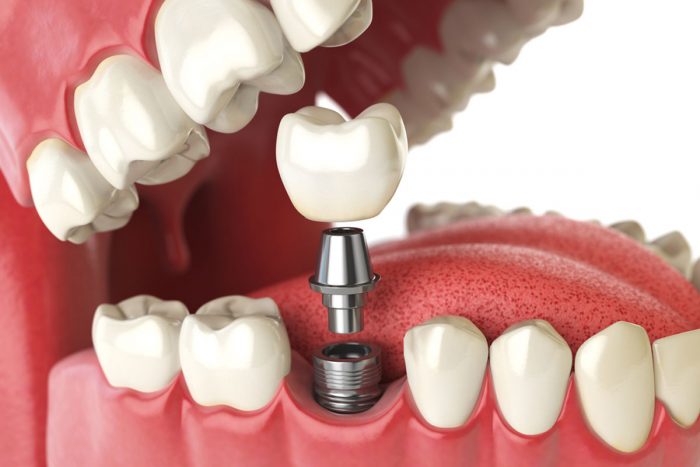 Dental Implants Near Me | All-On-4 Dental Implants Sunny Isles, FL