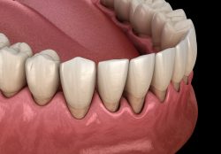 Gum Recession Treatment Surgery