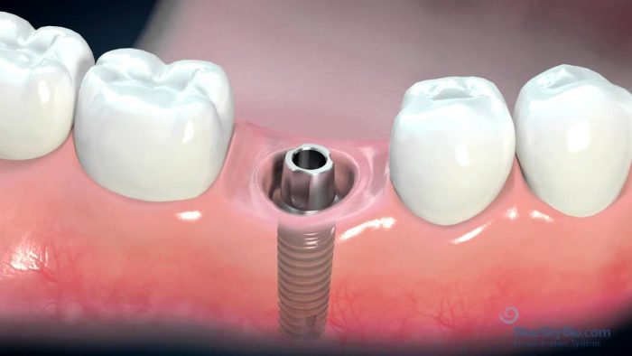 Dental Implant Surgery