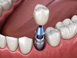 Full Mouth Dental Implants Recovery Time