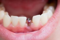 The Recovery Period After Getting Dental Implants