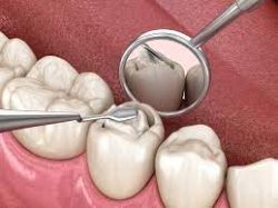Tooth Colored Fillings in Houston, TX | Natural Teeth Fillings