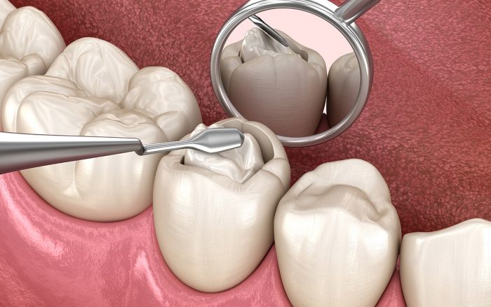 Composite Fillings Houston – Best Dental in TX