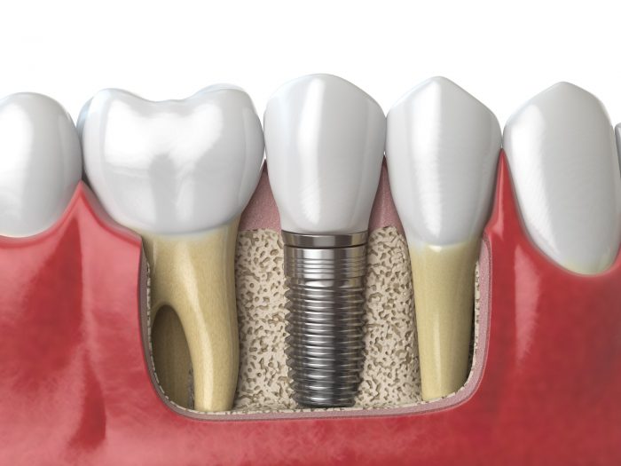 Dental Implants Houston