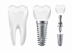 Cost of Dental Implants in Houston