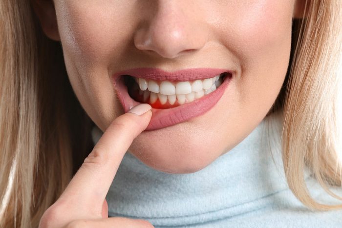 What Are Invisalign Attachments?