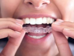 What Is Invisalign Treatment?