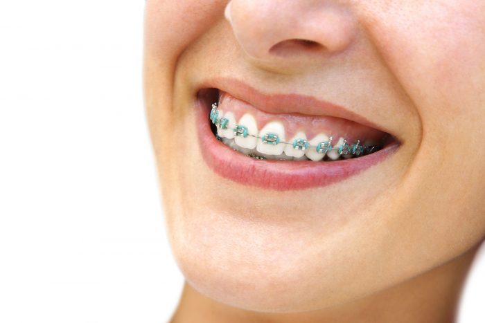 Invisalign Orthodontic Treatment