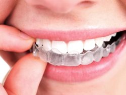 Best Invisalign Dentist in Houston