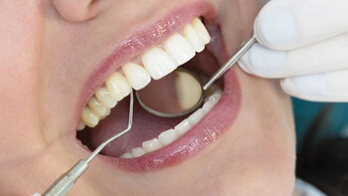 What Is Dental Veneer Treatment in houston