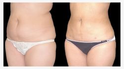 Treating BBL Liposuction Scars in Los Angeles