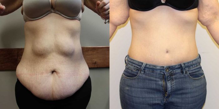 Tummy Tuck Before and After Photos