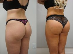 Brazilian Butt Lift Surgery Cost in houston