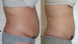 Arm Liposuction Before & After