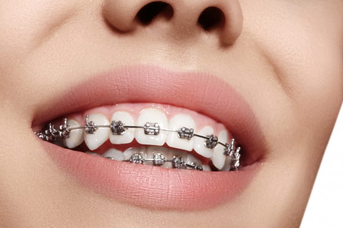 Orthodontic Braces Treatment In Houston