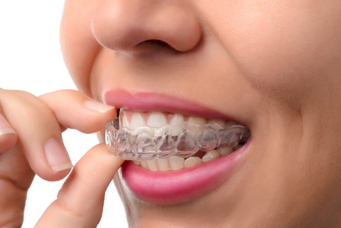 Adult Dental Braces Near Me