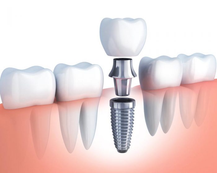 Dental Implant Procedure