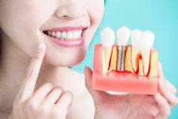 Dental Veneers For Crooked Teeth