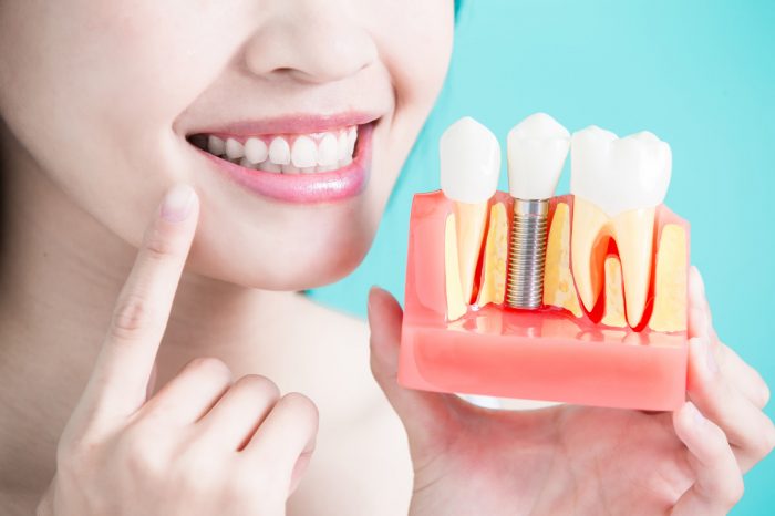 Dental Veneers For Crooked Teeth