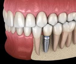 Best Dental Implants