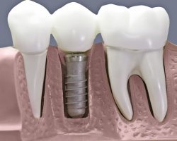 Best Dentist For Dental Implants