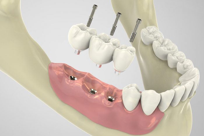 Knocked Out Teeth Treatment