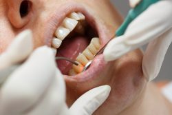 Cost of LANAP Dental Procedure