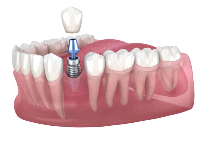 Dental Implant Options Near Me