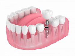 Dental Implants Multiple Missing Teeth